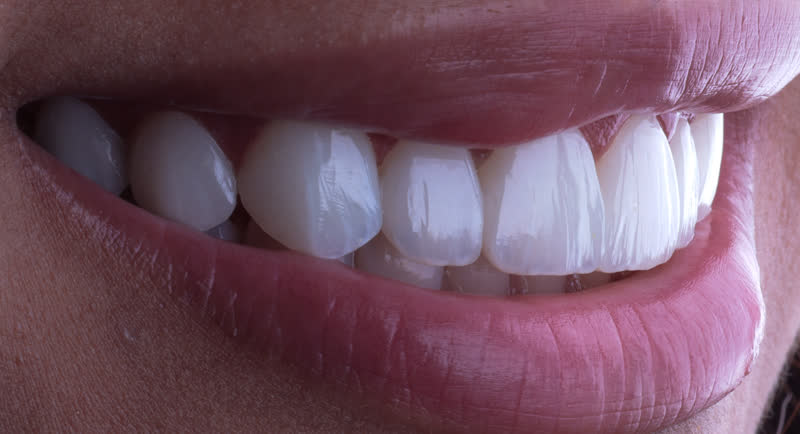 Sorriso com lentes de contato dental